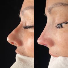 Dr. Alberto Cuevas - Rinoplastia