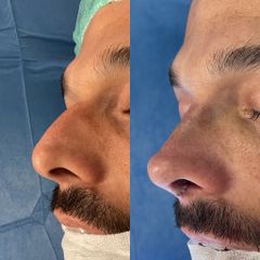 Dr. Alberto Cuevas - Rinoplastia