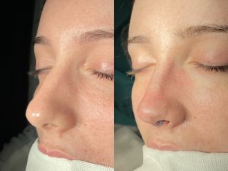 Rinoplastia antes y después - 875217