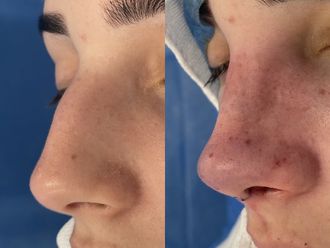 Rinoplastia antes y después - 875218