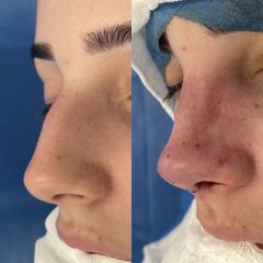 Rinoplastia - Dr. Alberto Cuevas