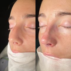 Rinoplastia - Dr. Alberto Cuevas
