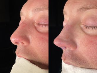 Rinoplastia antes y después - 875220