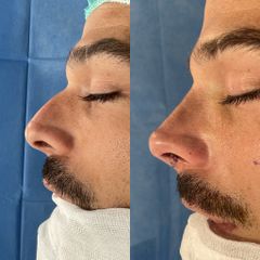 Rinoplastia - Dr. Alberto Cuevas