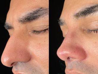 Rinoplastia antes y después - 875222