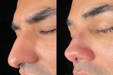 Rinoplastia - Dr. Alberto Cuevas