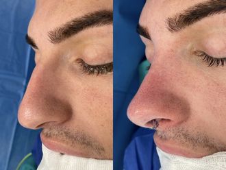 Rinoplastia antes y después - 875223