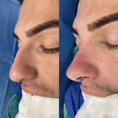 Rinoplastia - Dr. Alberto Cuevas