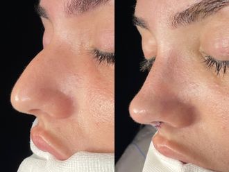 Rinoplastia antes y después - 875224