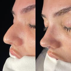 Rinoplastia - Dr. Alberto Cuevas