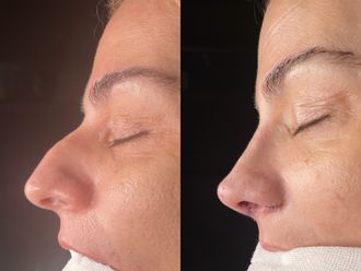 Rinoplastia antes y después - 875225