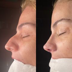 Rinoplastia - Dr. Alberto Cuevas