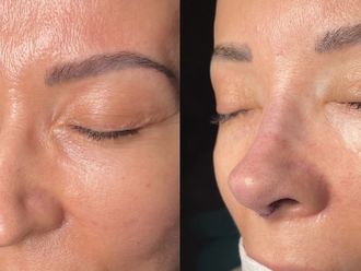 Rinoplastia antes y después - 875226