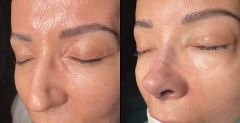 Rinoplastia - Dr. Alberto Cuevas