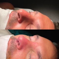 Rinoplastia - Dr. Alberto Cuevas