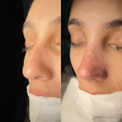 Rinoplastia - Dr. Alberto Cuevas