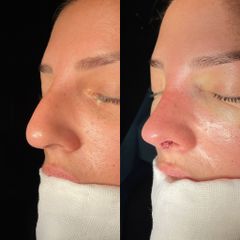 Rinoplastia - Dr. Alberto Cuevas