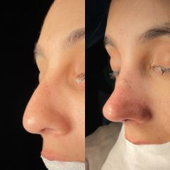 Rinoplastia - Dr. Alberto Cuevas
