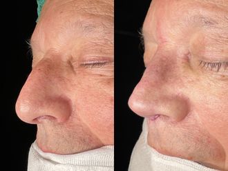 Rinoplastia antes y después - 875409
