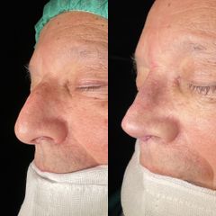 Rinoplastia - Dr. Alberto Cuevas