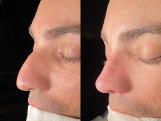 Rinoplastia antes y después - 875410