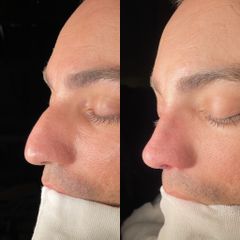 Rinoplastia - Dr. Alberto Cuevas