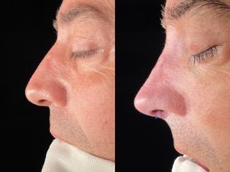 Rinoplastia antes y después - 875411
