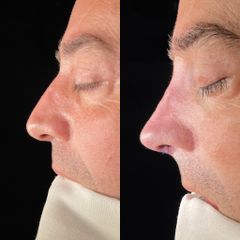 Rinoplastia - Dr. Alberto Cuevas