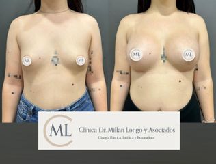 Aumento de pecho - Clínica Dr. Millán Longo y Asociados
