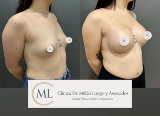 Aumento de pecho - Clínica Dr. Millán Longo y Asociados
