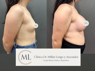 Aumento de pecho - Clínica Dr. Millán Longo y Asociados