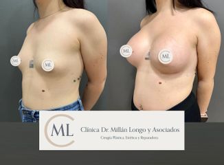 Aumento de pecho - Clínica Dr. Millán Longo y Asociados