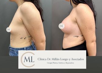 Aumento de pecho - Clínica Dr. Millán Longo y Asociados