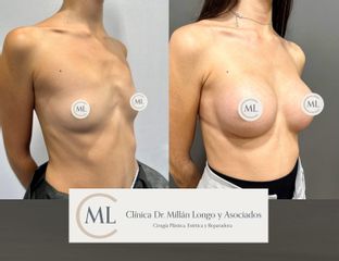 Aumento de pecho - Clínica Dr. Millán Longo y Asociados