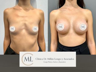 Aumento de pecho - Clínica Dr. Millán Longo y Asociados