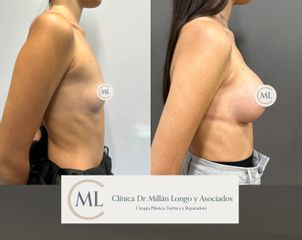 Aumento de pecho - Clínica Dr. Millán Longo y Asociados
