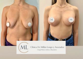 Mastopexia con prótesis