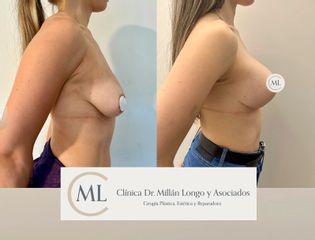 Mastopexia con prótesis
