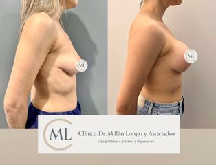 Mastopexia con prótesis