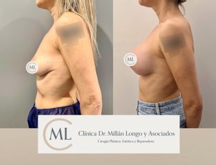 Mastopexia con prótesis