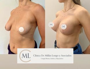 Mastopexia con prótesis