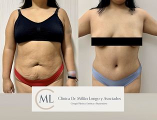 Abdominoplastia