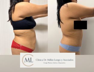 Abdominoplastia