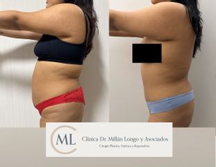 Abdominoplastia