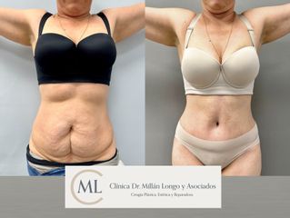 Abdominoplastia