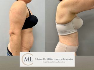 Abdominoplastia
