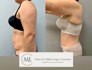 Abdominoplastia