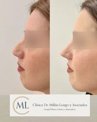 Rinoplastia ultrasónica