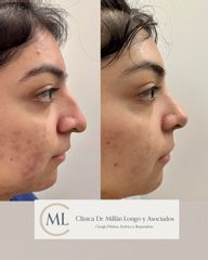 Rinoplastia ultrasónica