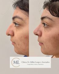 Rinoplastia ultrasónica